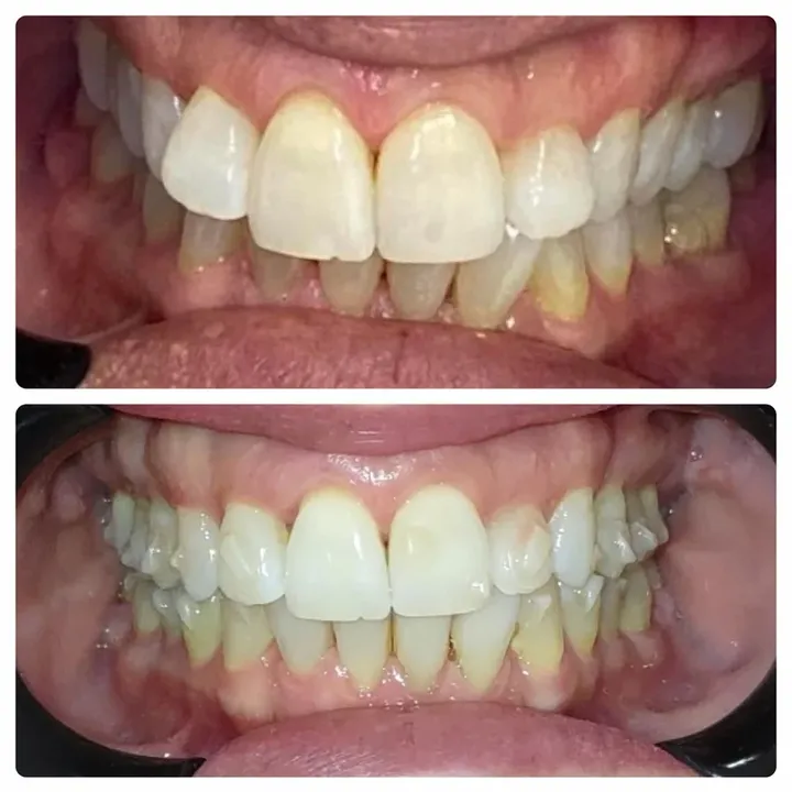 Caso real: dentes de cima cobrindo demais os de baixo, no início e no final do tratamento