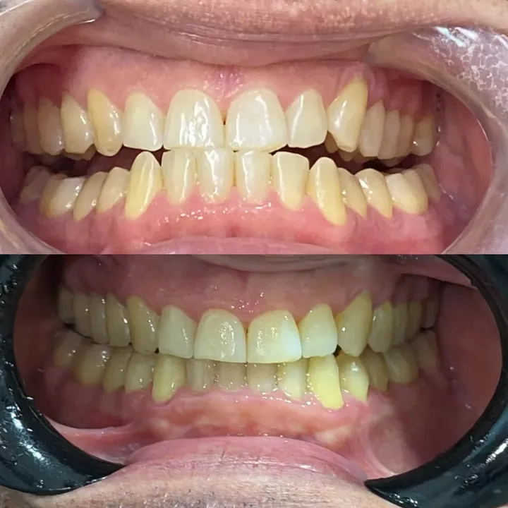 Caso real: mordida e dentes desalinhados, no início e no final do tratamento