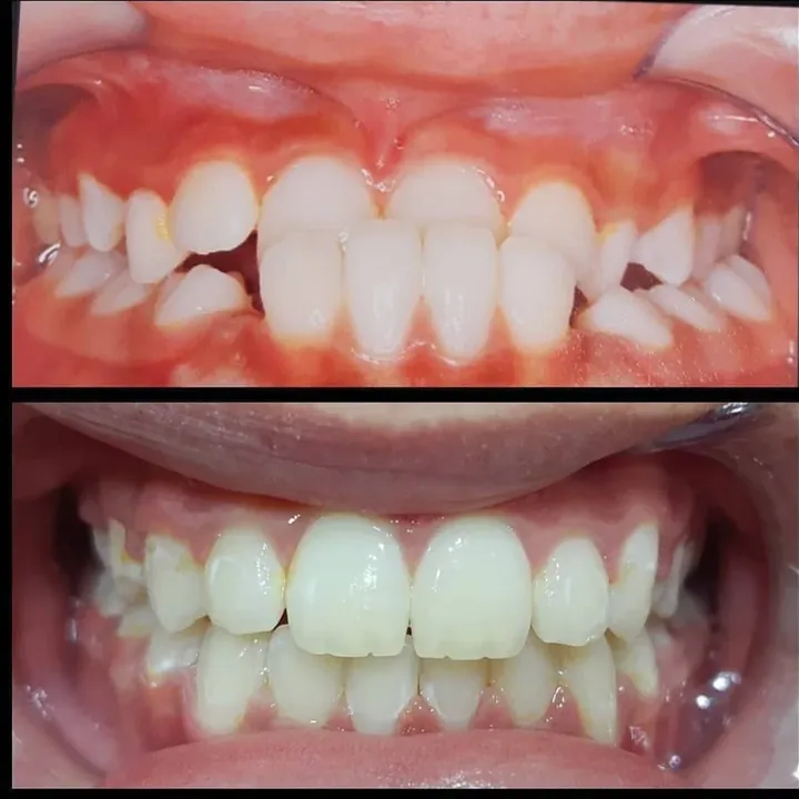 Caso real: dentes de baixo à frente dos de cima, no início e no final do tratamento